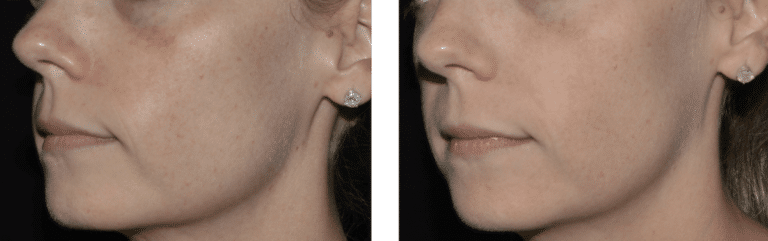 pigmentation before and after