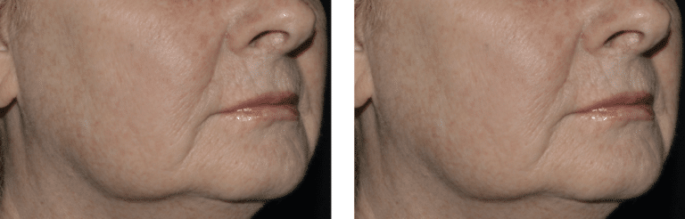 pigmentation before and after